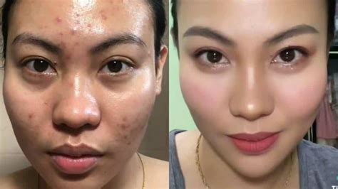 Tretinoin Before And After Pictures And Videos Drug Genius