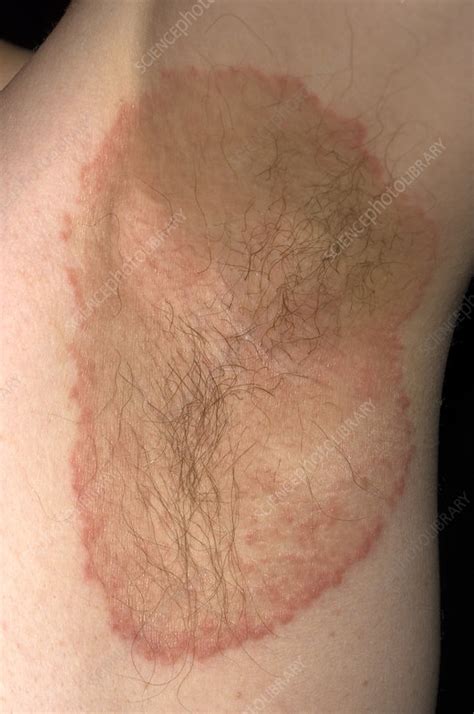 Ringworm Rash Under Armpit