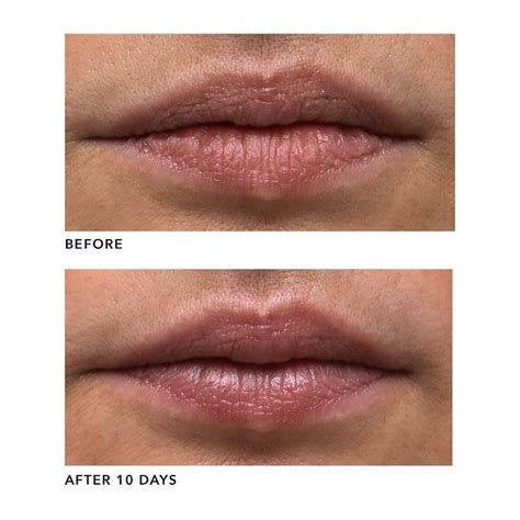 Genius Liquid Collagen Lip Collagen Lips Lip Wrinkles Lip Treatment