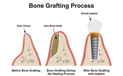 Bone Grafting Perioclinik Dr Freddy Fokam