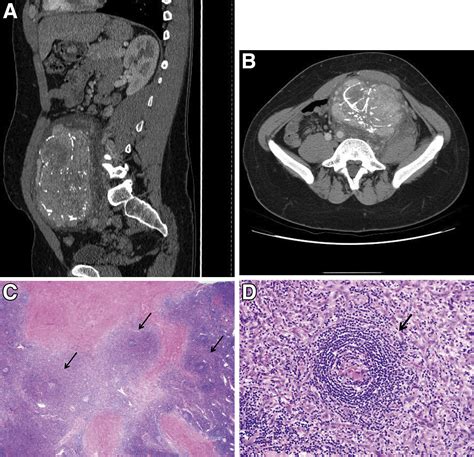 A Large Retroperitoneal Mass In An Asymptomatic 22 Year Old Man