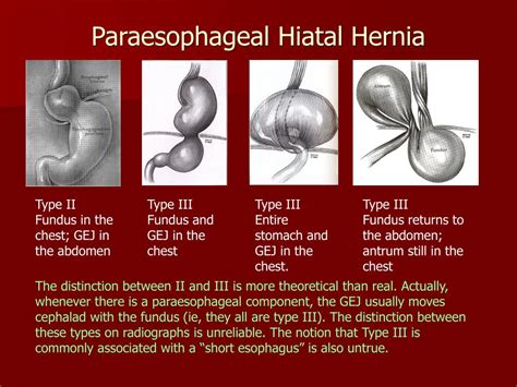 Ppt Laparoscopic Paraesophageal Hiatal Hernia Repair And Sexiz Pix