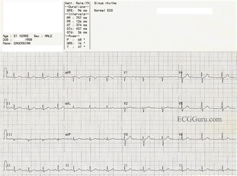 Jan 01, 2021 · ncbi bookshelf. Normal ECG | ECG Guru - Instructor Resources
