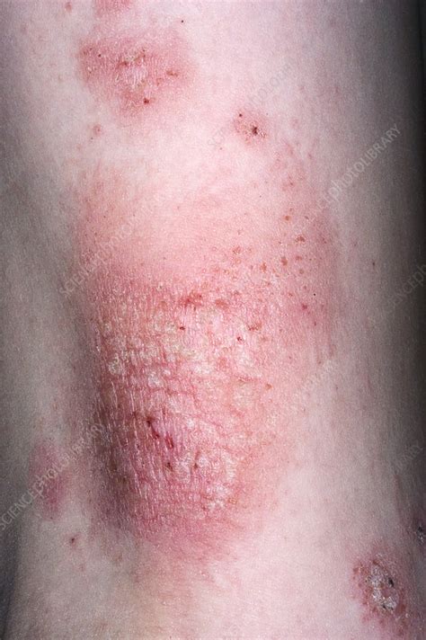 Eczema Stock Image M1500320 Science Photo Library