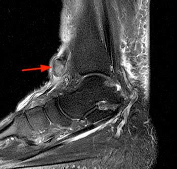 MRI Musculo Skeletal Section Complete Rupture Of The Anterior Tibial Tendon