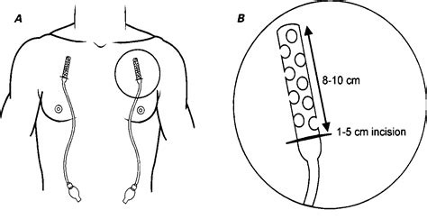 Figure 1 From The Use Of Subcutaneous Drains To Manage Subcutaneous
