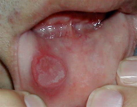 Hiv Tongue Lesions