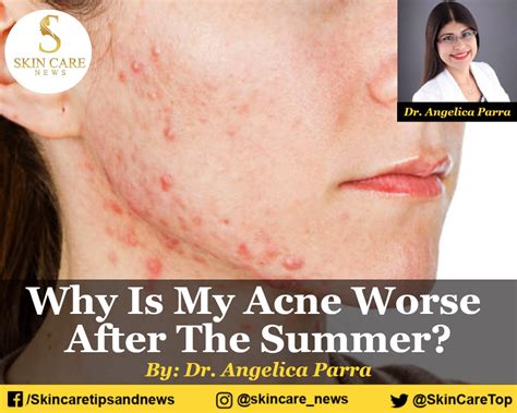 Why Is My Acne Worse After The Summer Skin Care Top News