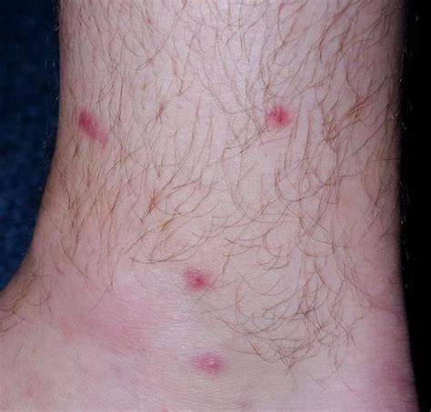 Bug Bite Identification The 10 Most Common Bug Bites And How To