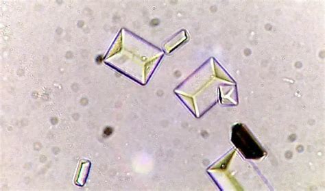 Types Of Crystals Found In Human Urine And Their Clinical Significance