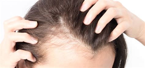 Hair Loss Dermatology And Skin Health Dr Mendese
