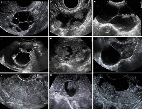 Imaging In Gynecological Disease 12 Clinical And Ultrasound Features
