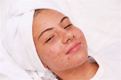 Premium Photo Acne A Smiling Teenage Girl With Pimples On Her Face