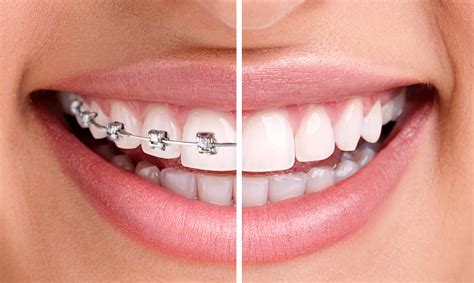 traditional metal braces vs new clear braces dr mario paz