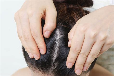 Sweaty Scalp Causes Treatments And Best Solutions For Sweaty Scalp