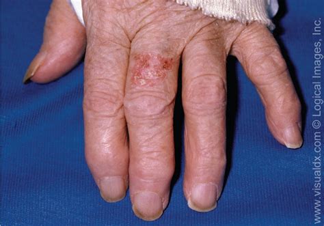 Diagnosis And Treatment Of Basal Cell And Squamous Cell Carcinoma Aafp