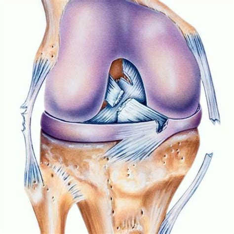 Multi Ligament Knee Reconstruction Complex Knee Injury Repair