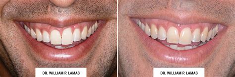 Periodontal Plastic Surgery Before And After Photos Dr William Lamas