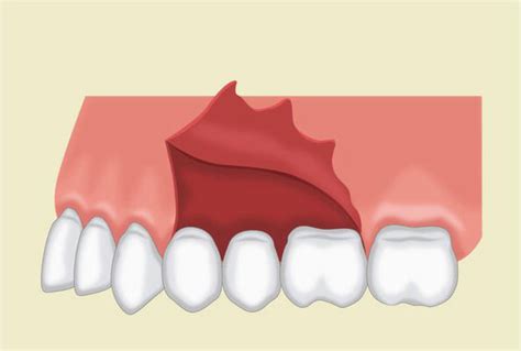 Flap Techniques In Dentoalveolar Surgery Intechopen