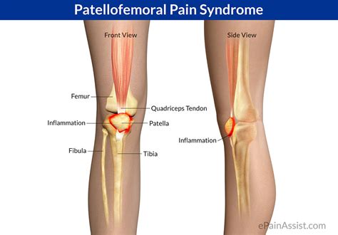Patellofemoral Pain Syndrome Podiatry HQ