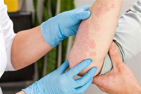 Begleiterkrankungen Der Psoriasis Leben Mit