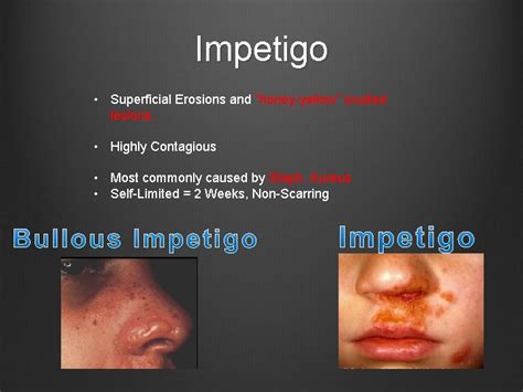 Skin Pathology Iii Pemphigus Vulgaris Type Ii Hypersensitivity
