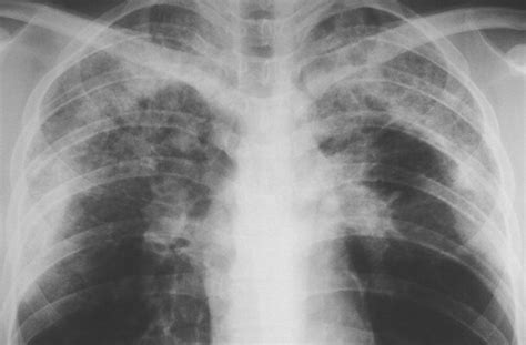 Eosinophilic Lung Diseases A Clinical Radiologic And Pathologic