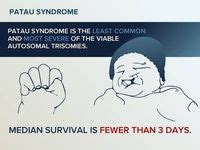 Trisomy 13 Aka Patau Syndrome Patau Syndrome Trisomy 13 Cleft Palate
