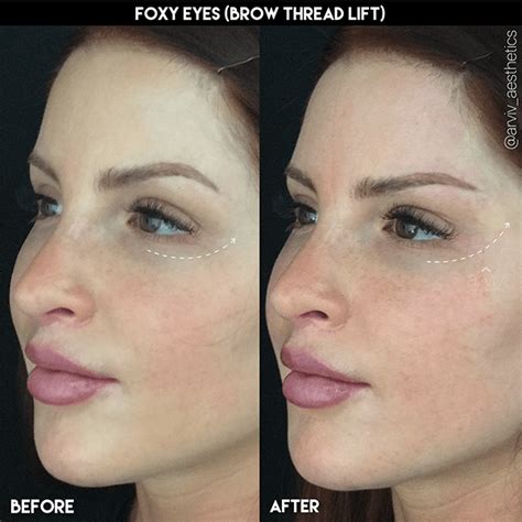 Tampa Pdo Thread Lift Non Surgical Facelift Arviv Medical Aesthetics