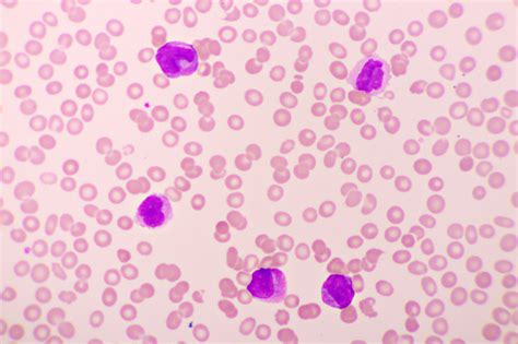 Acute Promyelocytic Leukemia Cells Or Apl Stock Photo Download Image