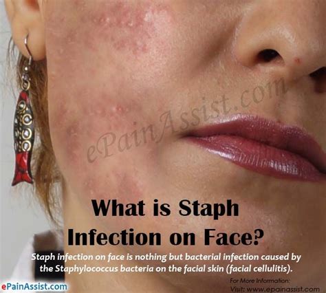 Cool What Does A Staph Infection Look Like On Your Face