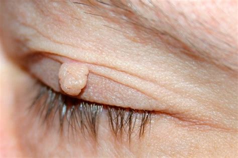 everything you need to know about removing skin tags on eyelids