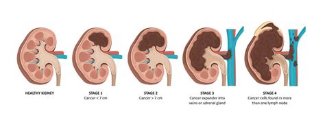 Kidney Cancer Stages Stock Illustration Download Image Now Istock