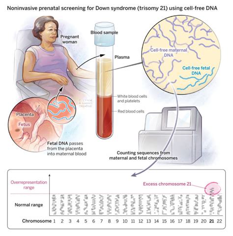 Non Invasive Prenatal Testing Using Fetal Dna Springerlink Sexiz Pix