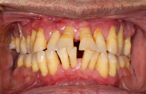 Gum Disease Symptoms And Treatment The Implant Experts