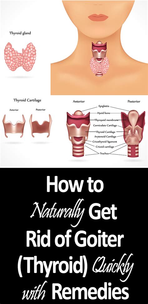 15 Diy Home Remedies For Goiter Thyroid Wish I Would Of Know This