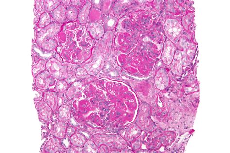 Doublet of lobo and wolf. Lupus nephritis - Wikipedia