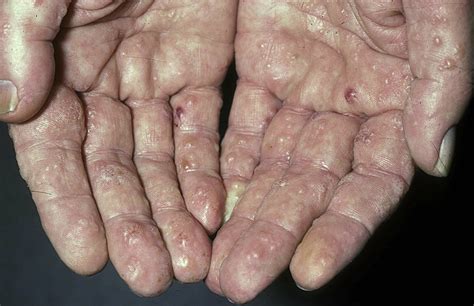 Acute And Recurrent Vesicular Hand Dermatitis Dermatologic Clinics