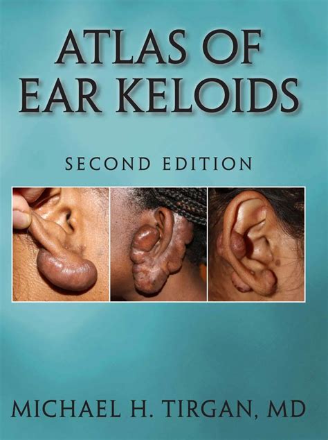 Atlas Of Ear Keloids Keloids Information Guide By Dr Tirgan