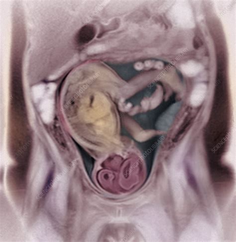 List 94 Pictures Baby At 36 Weeks In The Womb Pictures Superb