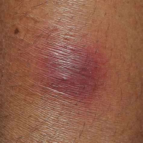 Erythema Nodosum Lecturio Online Medical Library