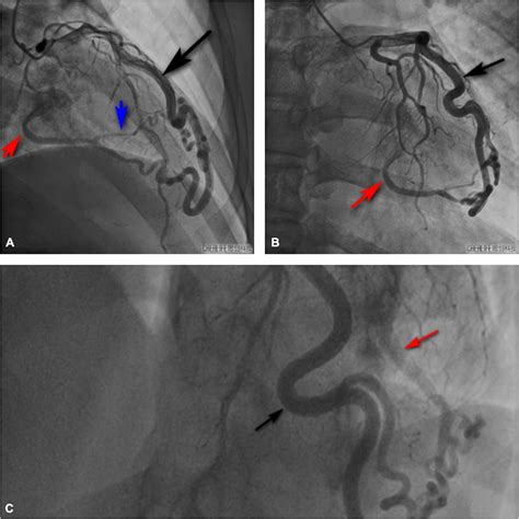 Frontiers Giant Left Coronary Artery Diagonal Branch Left Ventricular