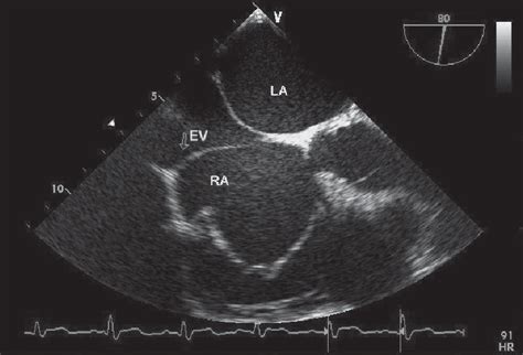 Transesophageal Echocardiography Reveals A Long Eustachian Valve