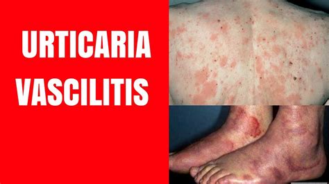 Urticarial Vasculitis Types Causes Symptoms Treatment Images And