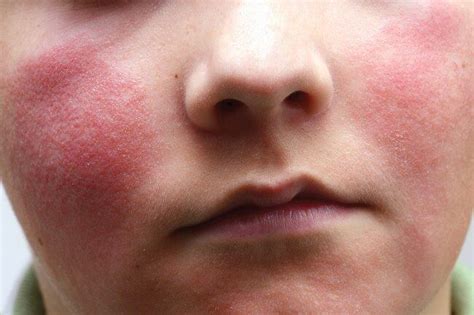 A Visual Guide To Viral Rashes Viral Rash Rash On Face Skin