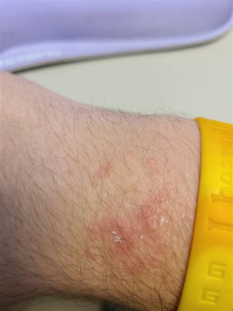 Weird Rash On Wrists And Hands Any Help Rdermatologyquestions