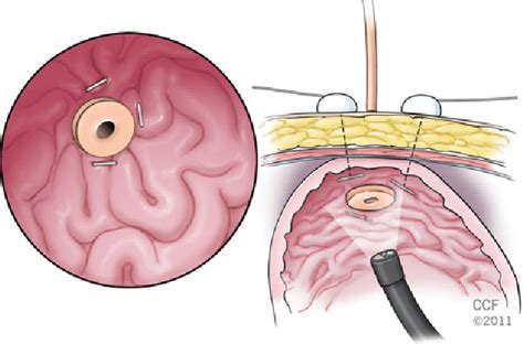 Figure 3 From Percutaneous Endoscopic Gastrostomy Peg