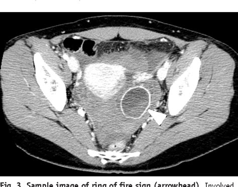 table 1 from ruptured corpus luteal cyst prediction of clinical outcomes with ct semantic scholar