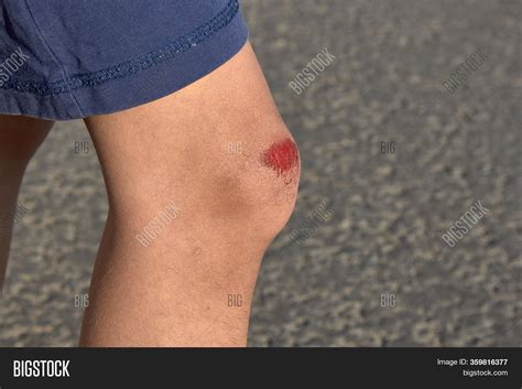 Bruised Wound On Knee Image And Photo Free Trial Bigstock