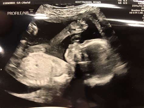 20 Week Ultrasound Stay At Home Zookeeper
